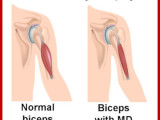 Understanding Muscular Dystrophy, Its Symptoms and Treatment