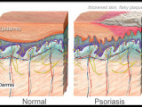 The Dreaded Skin Disease Called Psoriasis And How to Treat It