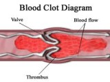 Dangers of Blood Clotting and How You Can Treat It