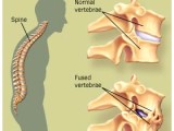 What is Ankylosing Spondylitis and How Can It Be Treated?