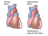 Hypertension: Understanding Its Symptoms,Risks and Treatment