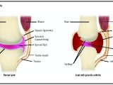 How Juvenile Arthritis Spoils Childhood