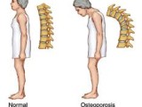 The Silent Disease: Osteoporosis And How It is Treated