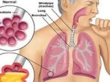 Pneumonia – Causes, Symptoms and Treatment