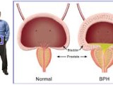 BPH - Benign Prostatic Hyperplasia – Causes and Treatment