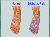 Why Diabetic Neuropathy is a Dangerous Complication of Diabetes