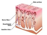 The Painful and Serious Disease Called Shingles   